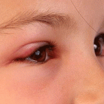 Khổ sở vì bệnh đau mắt đỏ ở trẻ nhỏ